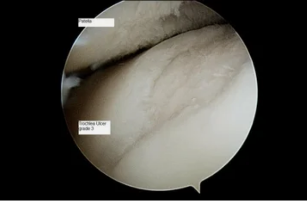 skats astroscope uz ceļa locītava ar osteoartrīts 3 th pakāpe