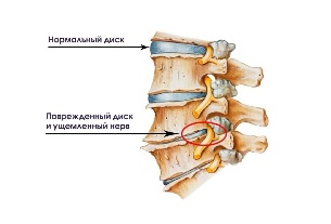 Simptomi no kakla osteohondrozes