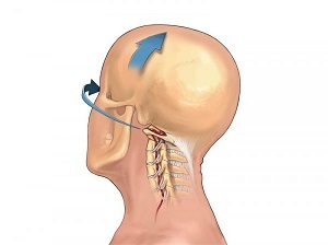 kā izpaužas mugurkaula kakla daļas osteohondroze