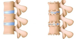 kā atpazīt mugurkaula jostas daļas osteohondrozes klātbūtni