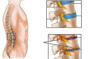 mugurkaula jostas daļas osteohondrozes cēloņi