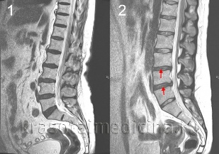 mugurkaula osteohondroze