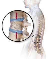 Osteoporoze izraisa muguras sāpes jostas rajonā